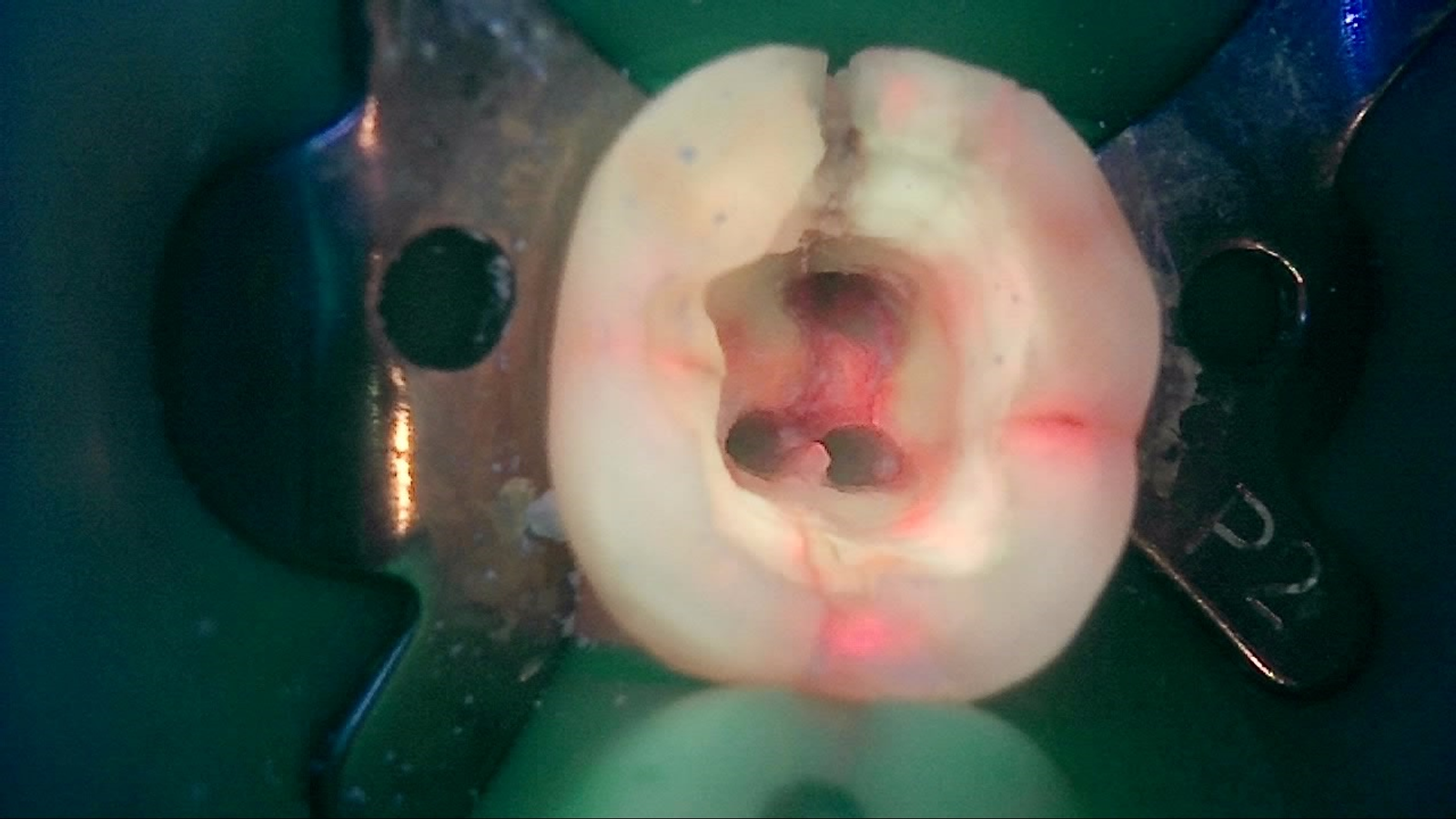 같은 치아의 치료 중 Qray 형광 사진, 와동 벽과 변연융선의 붉은 균열선