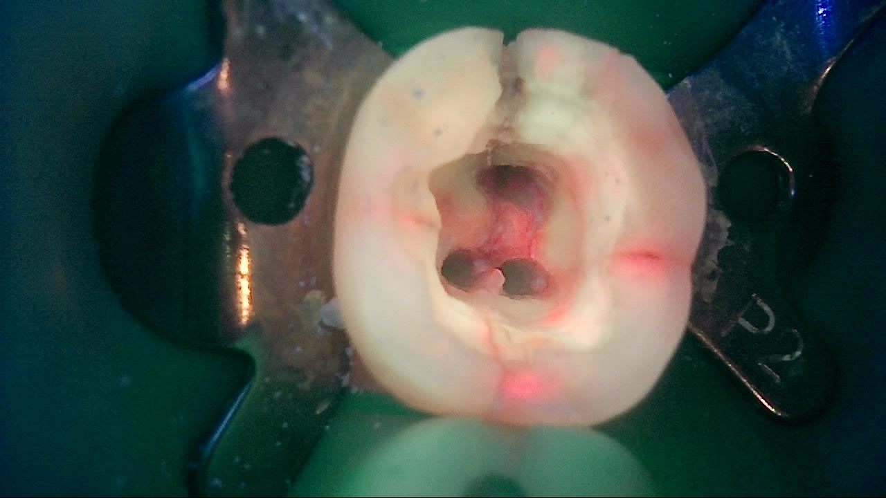 같은 치아의 치료 중 Qray 형광 사진, 와동 벽과 변연융선의 붉은 균열선