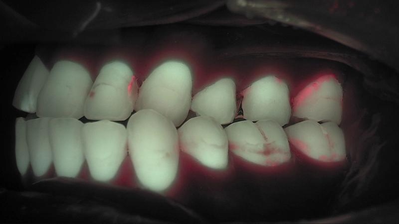 Qray fluorescence image of posterior teeth showing red fluorescence lines along cervical and interproximal margins, early caries detection, real clinical case