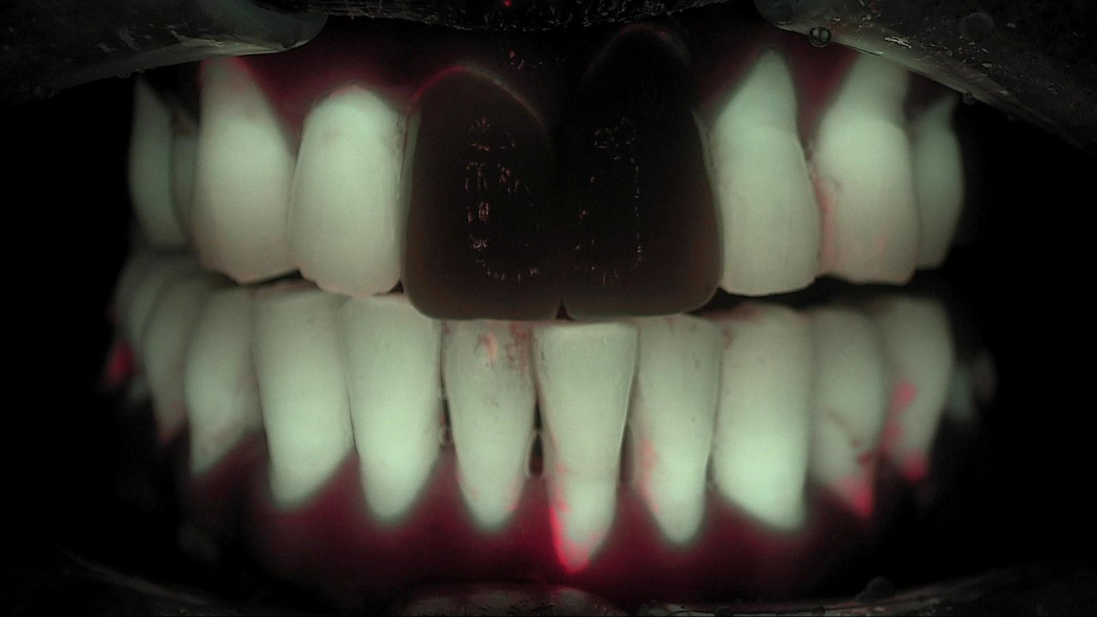 Qray fluorescence image recaptured ten months later from the same angle, showing reduced red areas in an intraoral photo comparison, real clinical case