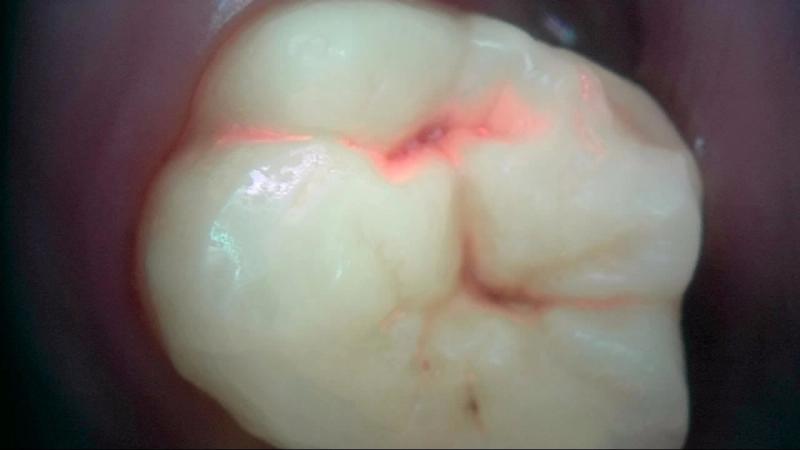 Qray fluorescence image of a molar occlusal surface — red fluorescence following the fissure around a small dark spot, real clinical case