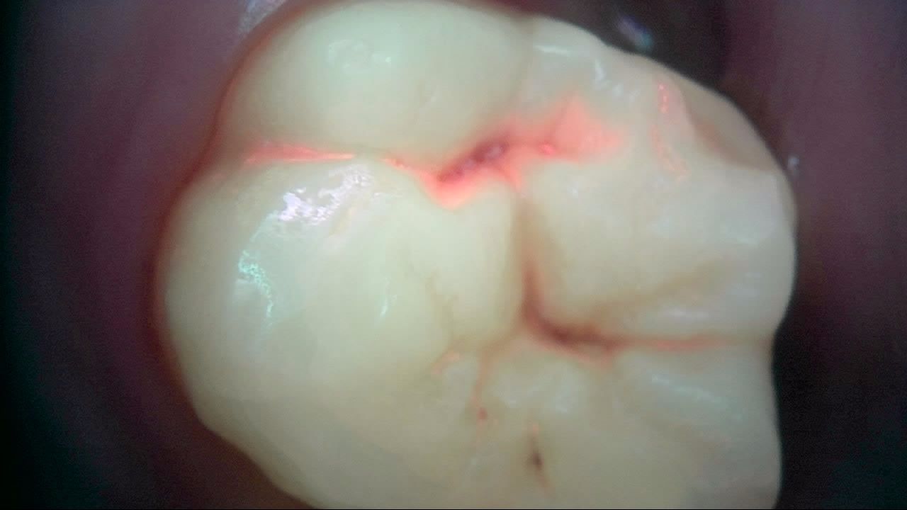 대구치 교합면 Qray 형광 사진 — 열구의 작은 검은 점 주변을 따라 붉은 형광이 보이는 실제 임상 사례