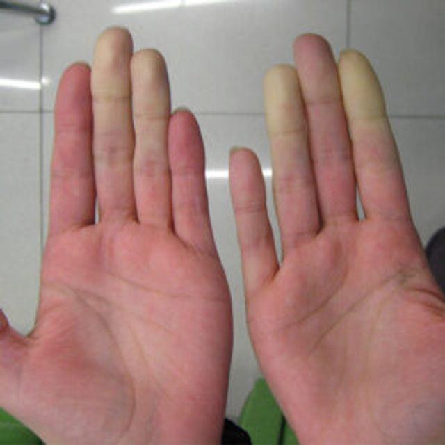 Occupational Vibration 