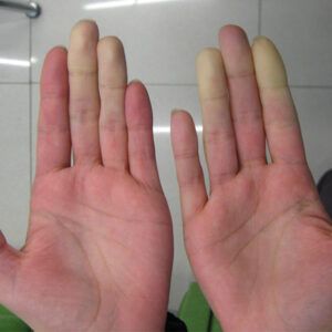 Occupational Vibration