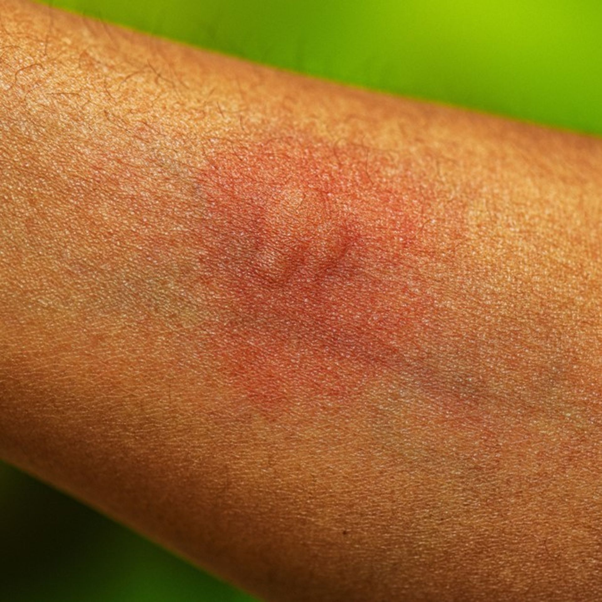 Insect and Spider Bites