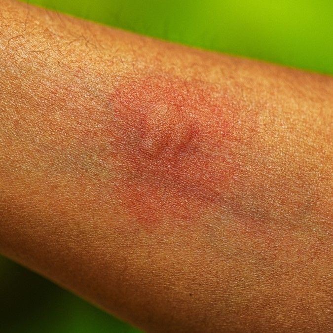 Insect and Spider Bites