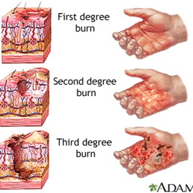 Burns 