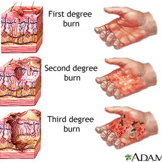 Burns