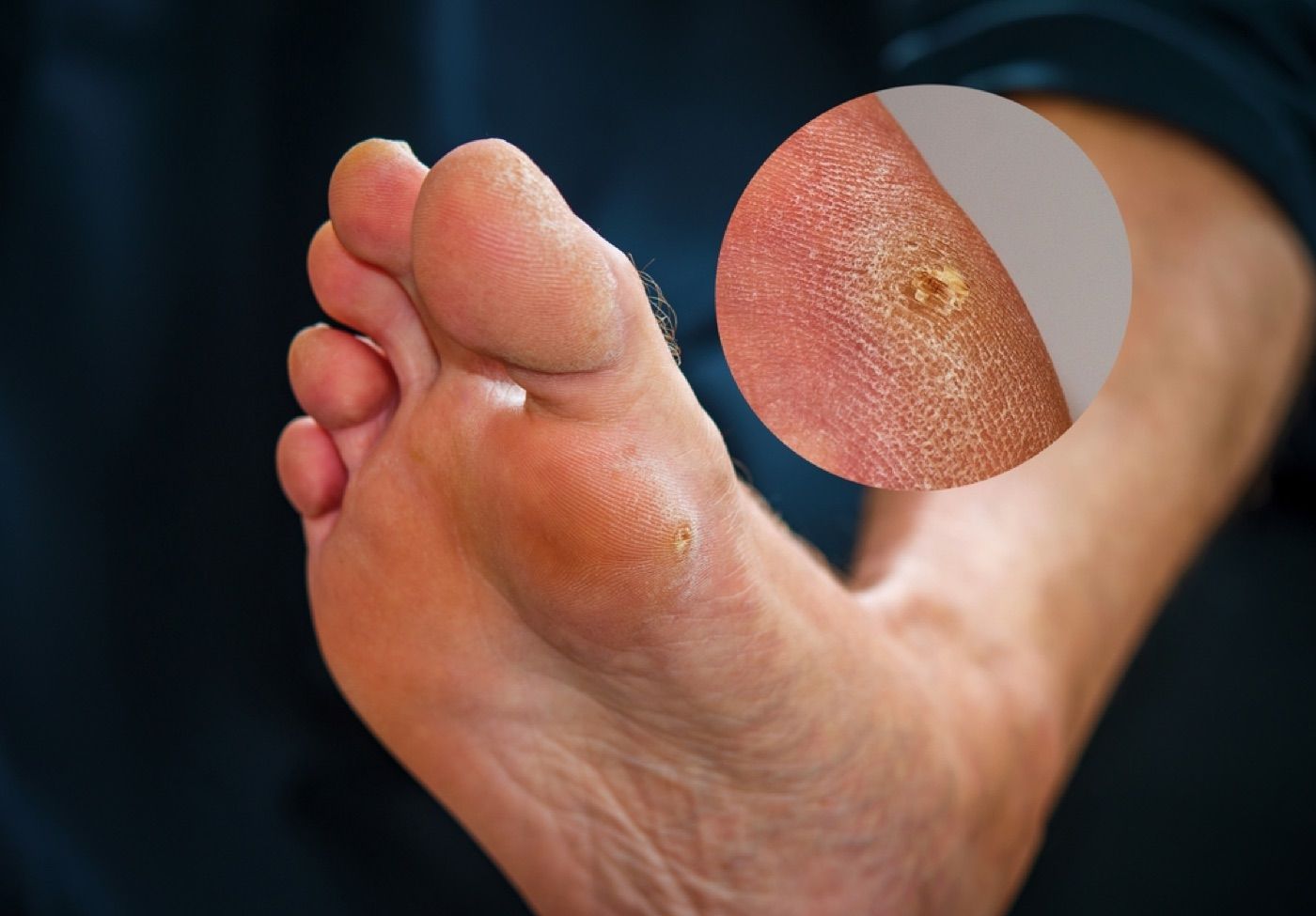 Foot showing hardened, thickened skin