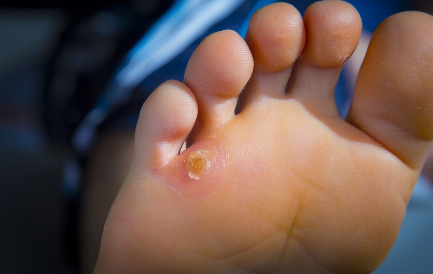 Close-up of skin affected by corns and calluses