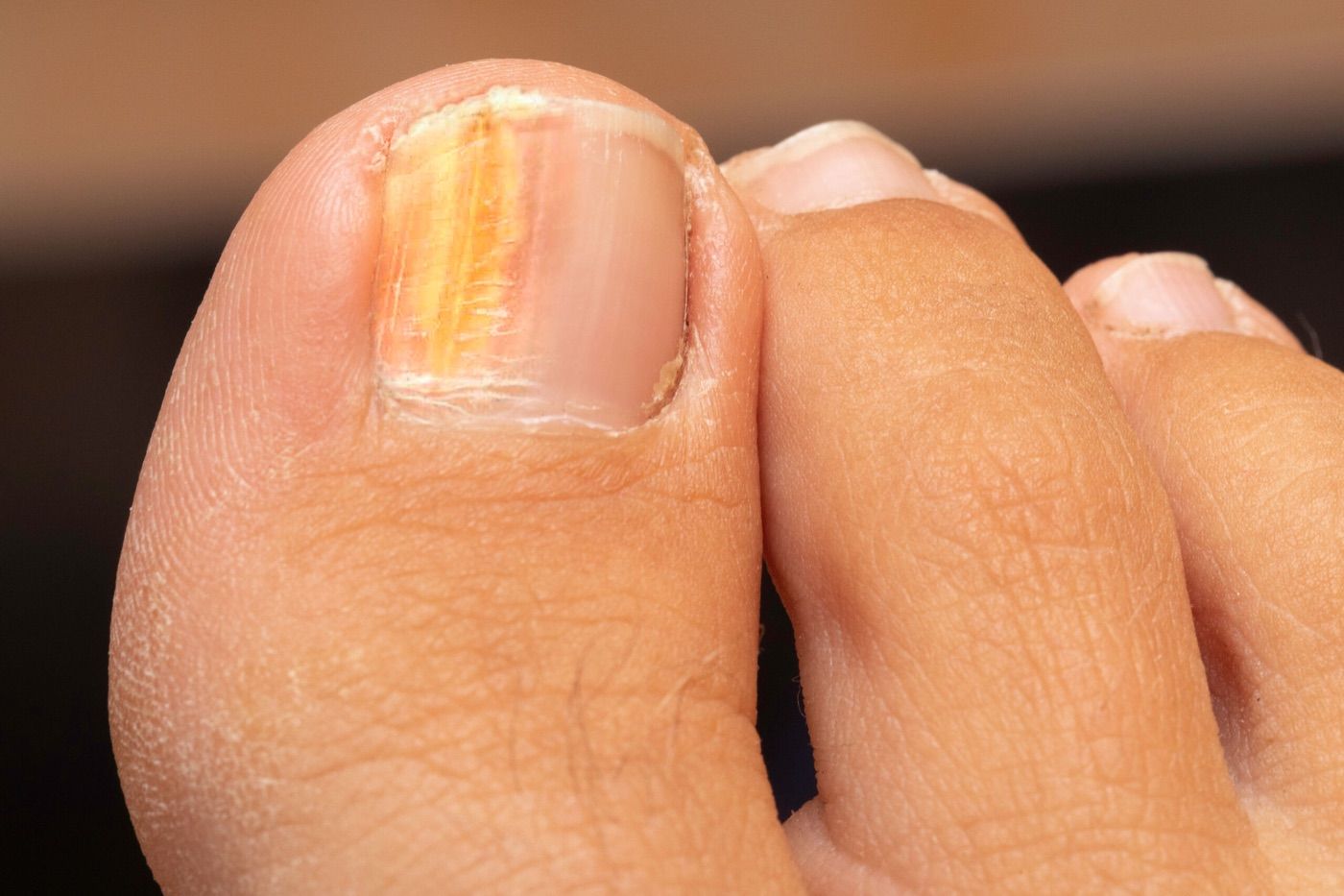 Close-up of toenails affected by fungal infection