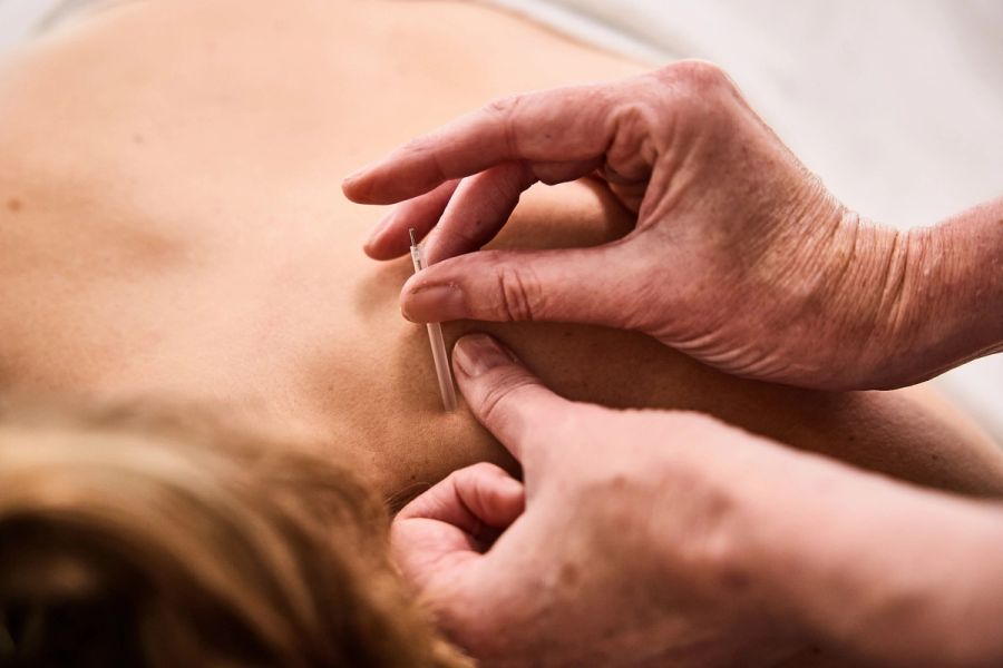 Close-up of a physiotherapist performing dry needling on a patient’s upper back