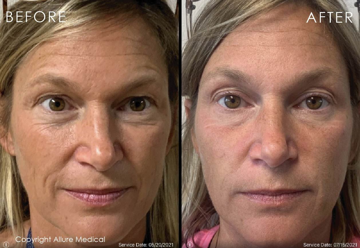 before and after of woman's face at Allure Medical