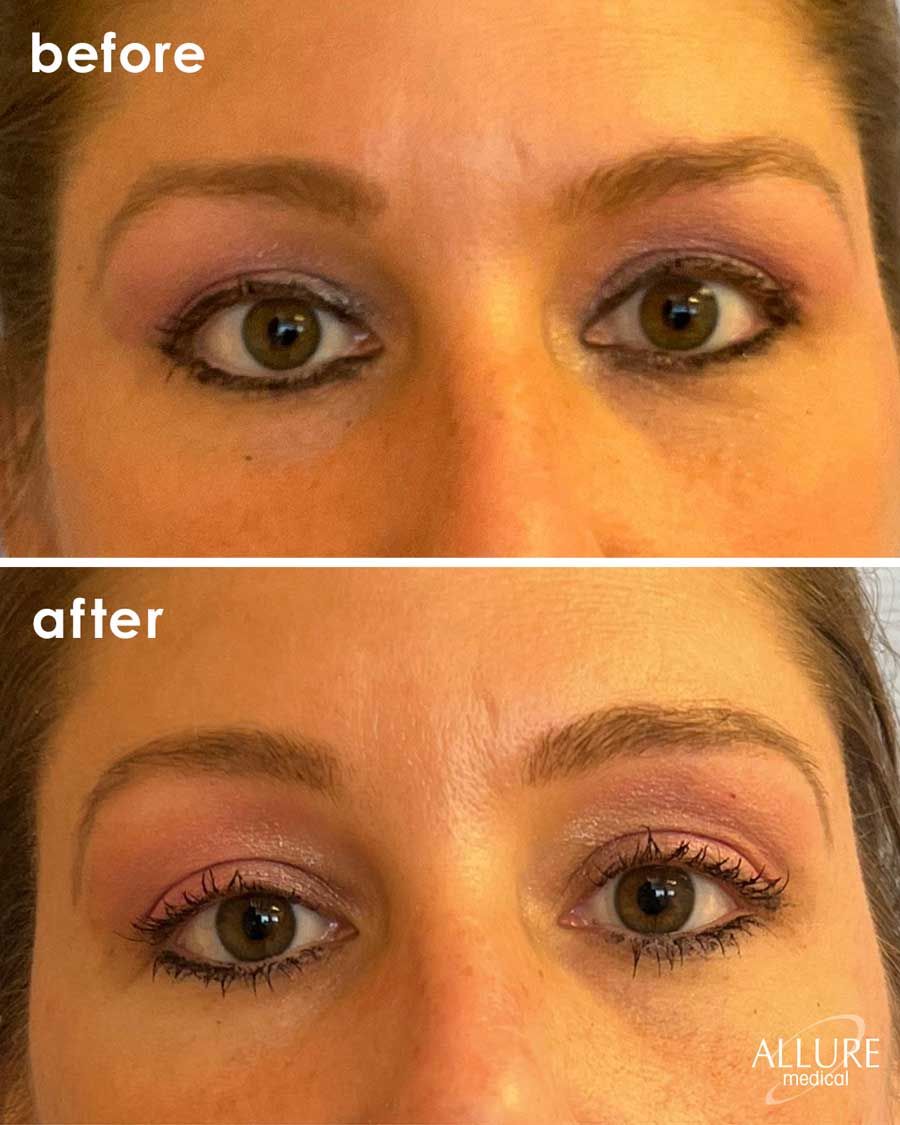 Before and After Botox® Cosmetics treatment #1