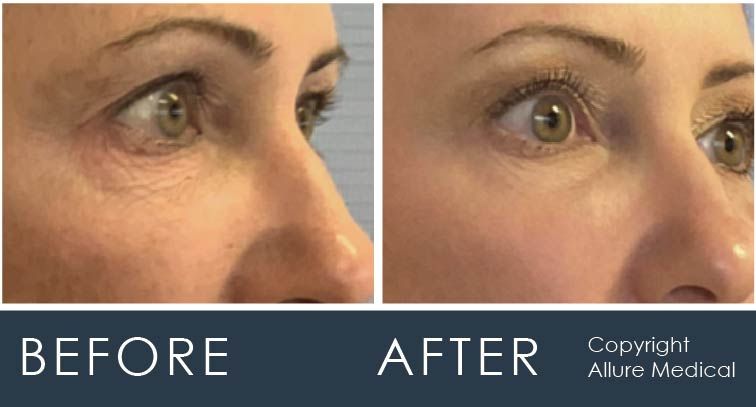 Fraxel before and after showing less wrinkles around the eyes at Allure Medical.