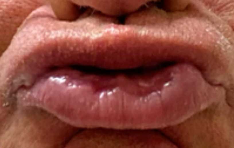 The deep lip muscles turn the pink of the lips out. deeper turn the lips out causing a "duck lip" effect.