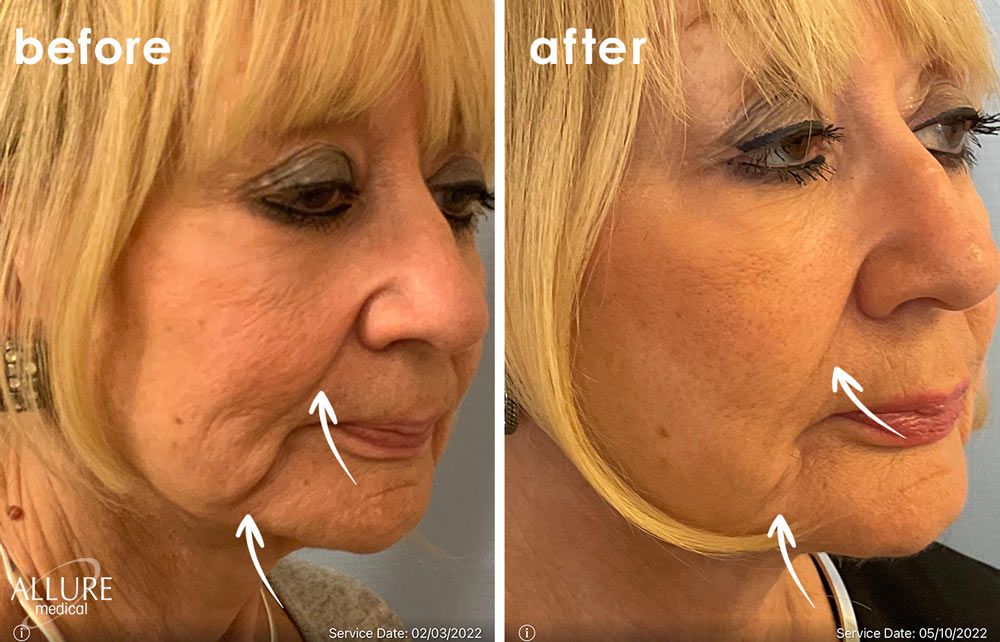 Before and After Thread Lift treatment #2