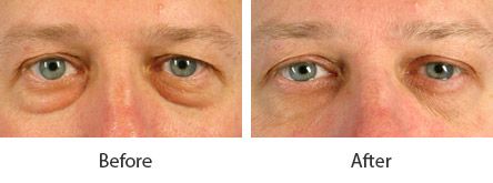Before and After Cosmetic Eyelid Surgery treatment #4