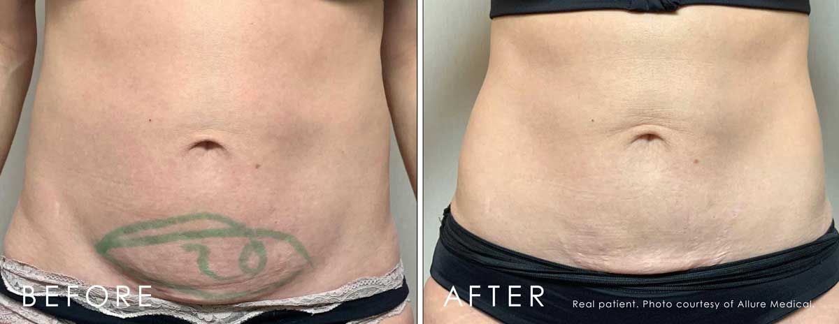 Before and After Lipodissolve treatment #3