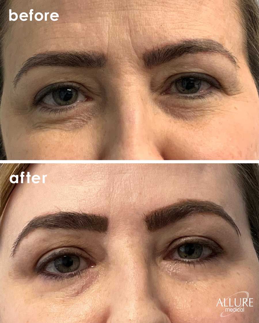 Before and After Botox® Cosmetics treatment #4