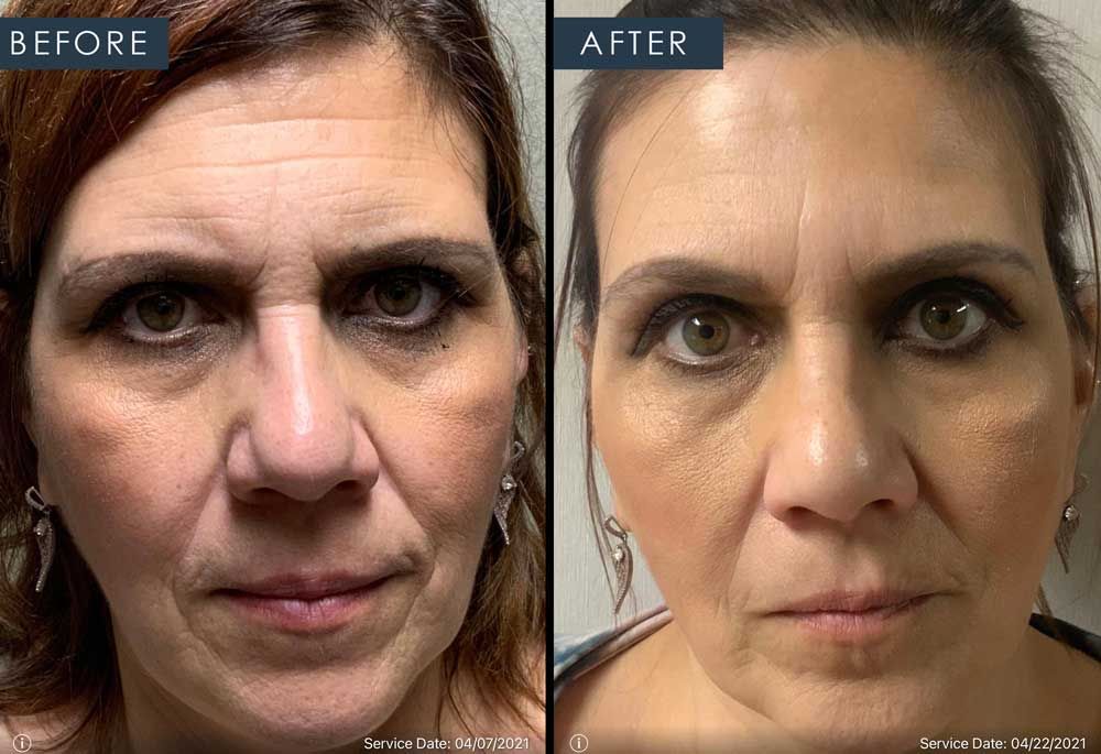 before and after photo of patient getting botox to the glabella and crow's feet