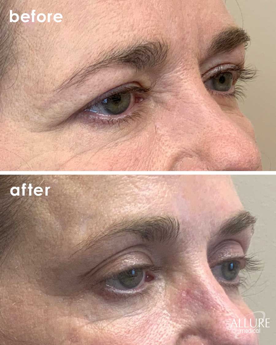 Before and After Botox® Cosmetics treatment #2