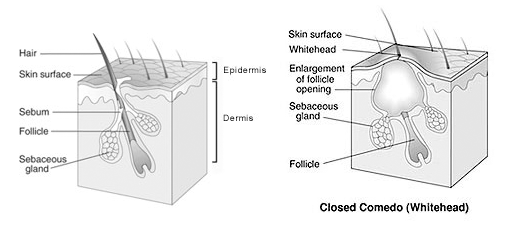 acne diagram