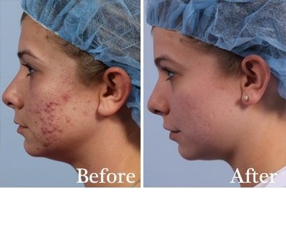 Before and After Fraxel Laser for Skin Resurfacing treatment #3