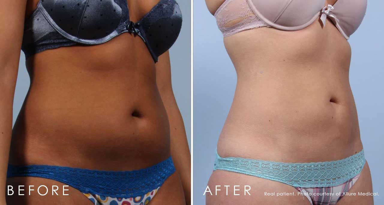 Before and After Liposuction treatment #2