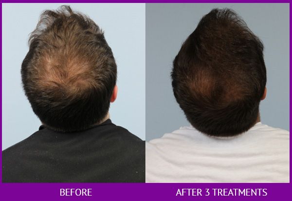 Before and After Platelet Rich Plasma (PRP) for Hair Restoration treatment #3