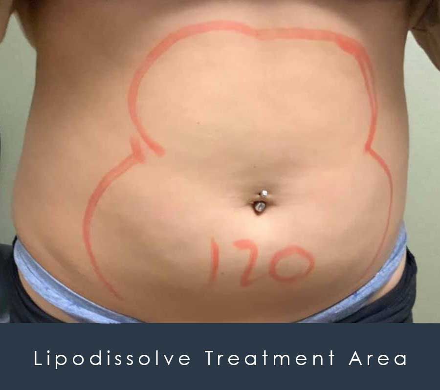 lipodissolve markings for procedure to remove fat