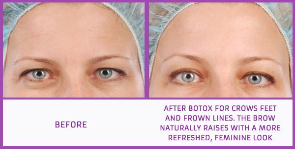Botox used for eyebrow lift