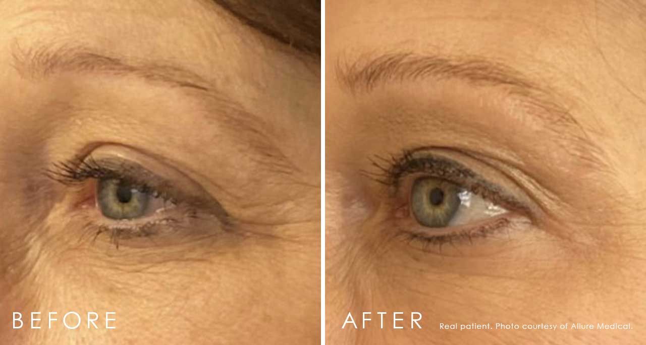 botox before and after eye of woman