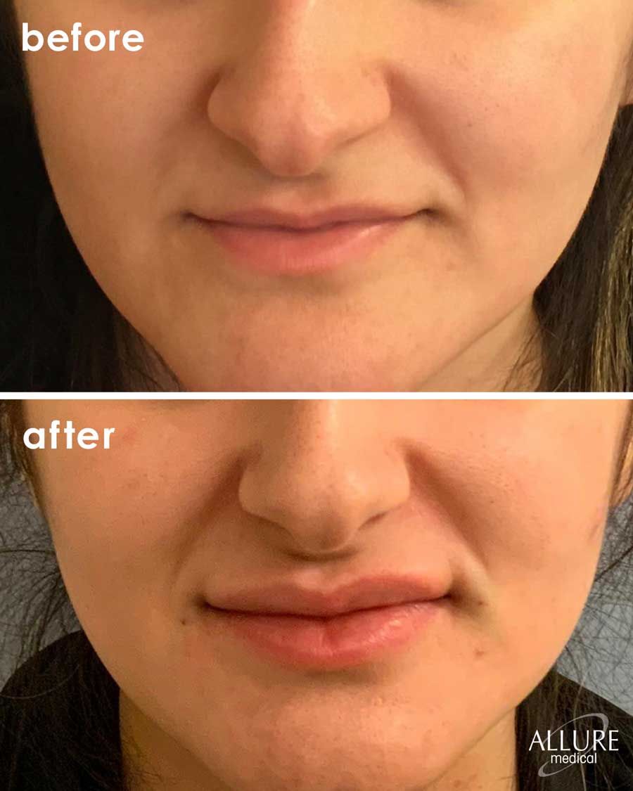 Before and After Lip Filler treatment #3