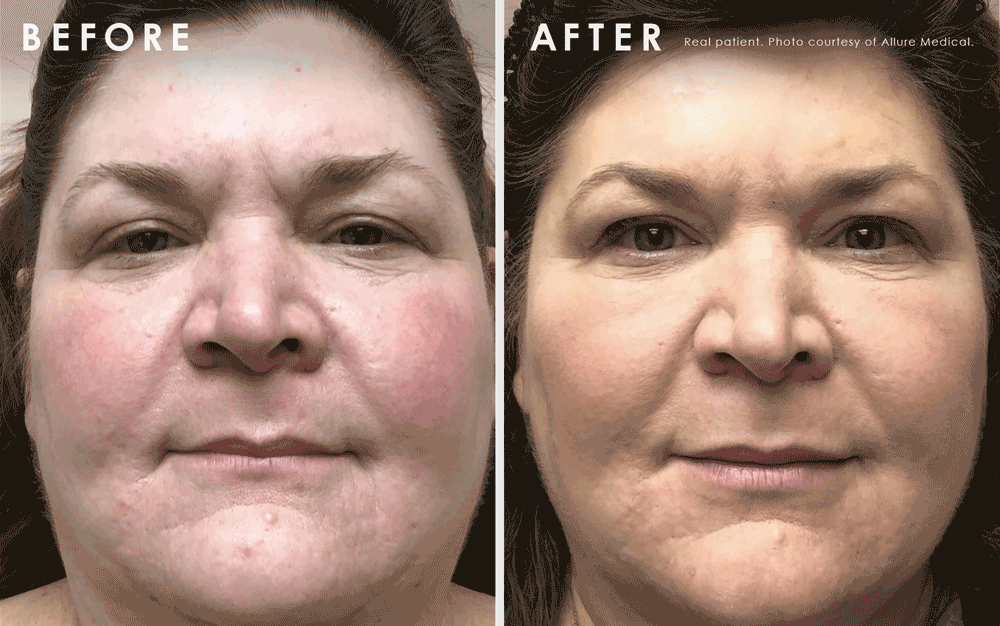 Magic lift before and after facial shape change from rectangle to triangle