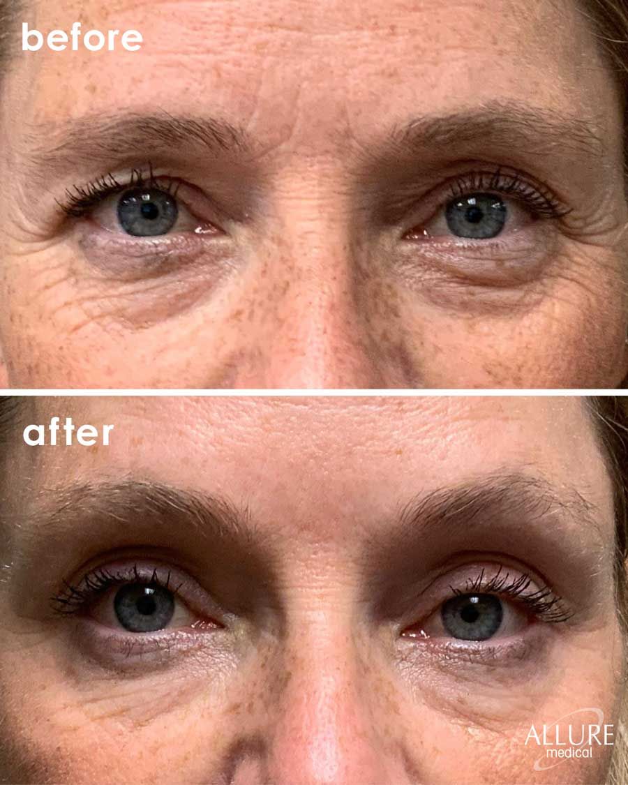 Before and After Botox® Cosmetics treatment #3