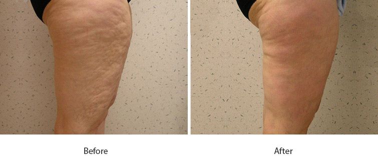 Before and After Cellulite Injections treatment #4