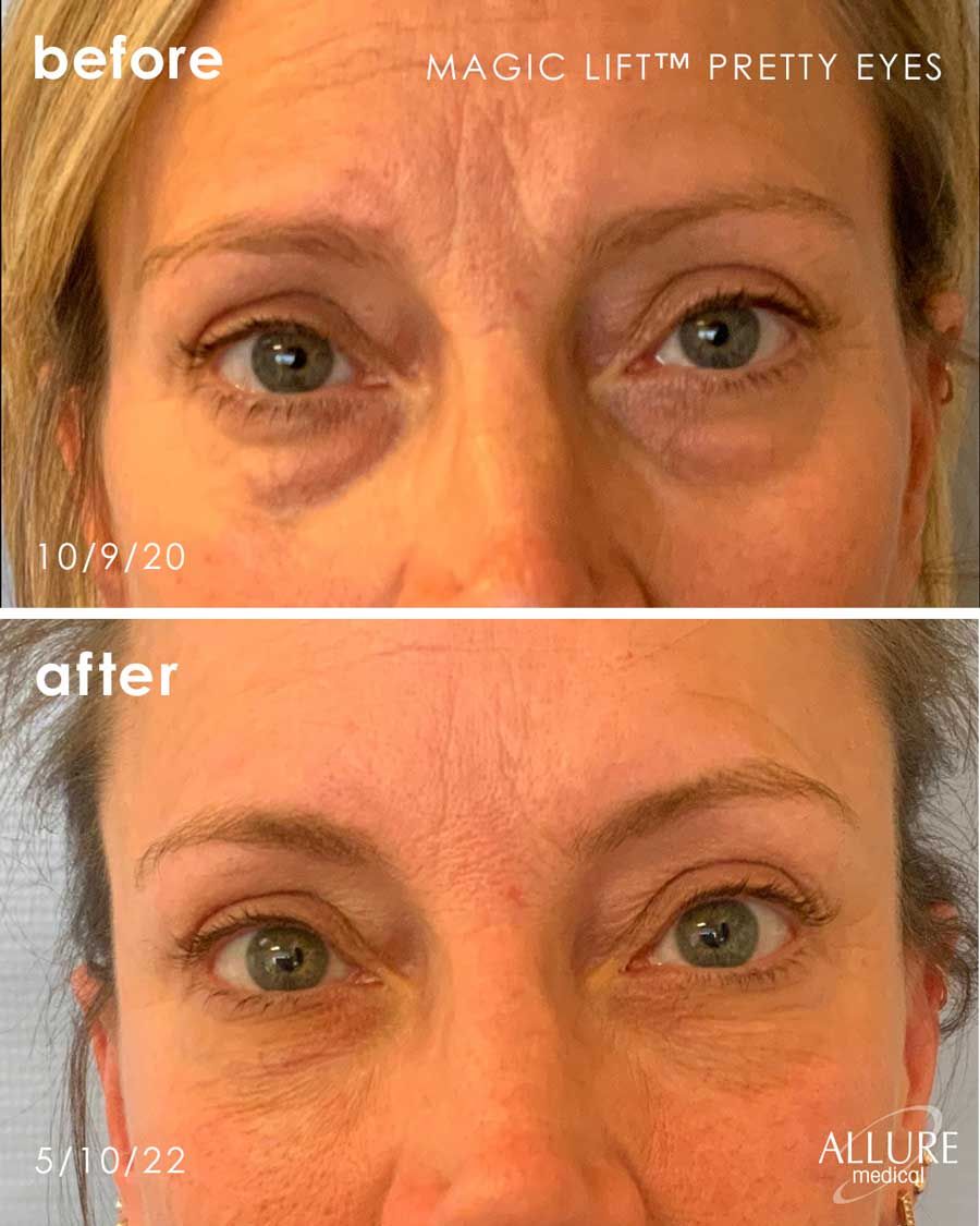 Before and After Magic Lift (Non-Surgical Face Lift) treatment #1