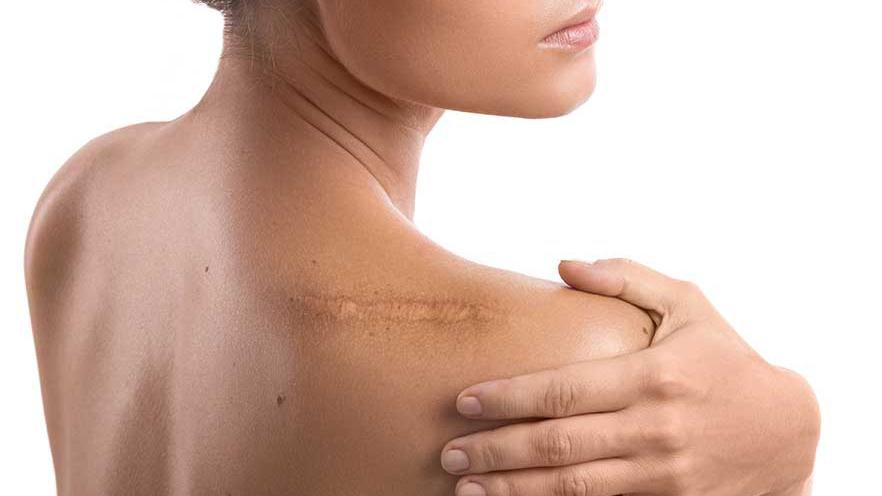 Keloids and Other Scar Treatment service thumbnail