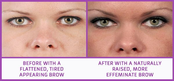 Botox used for brow lift