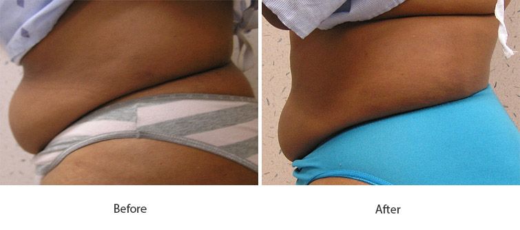 Before and After Cellulite Injections treatment #1