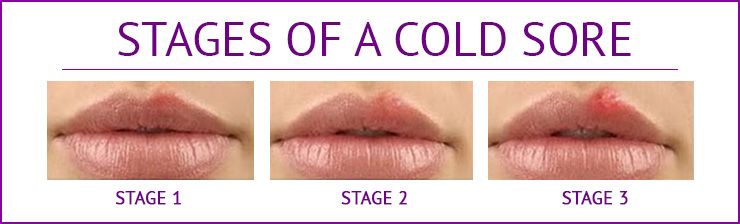 Managing A Cold Sore Outbreak Allure Medical