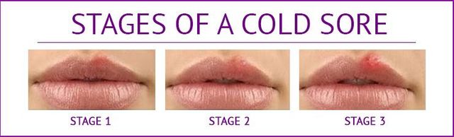 cold-sore-on-tongue-diagnosis-treatments-and-symptoms