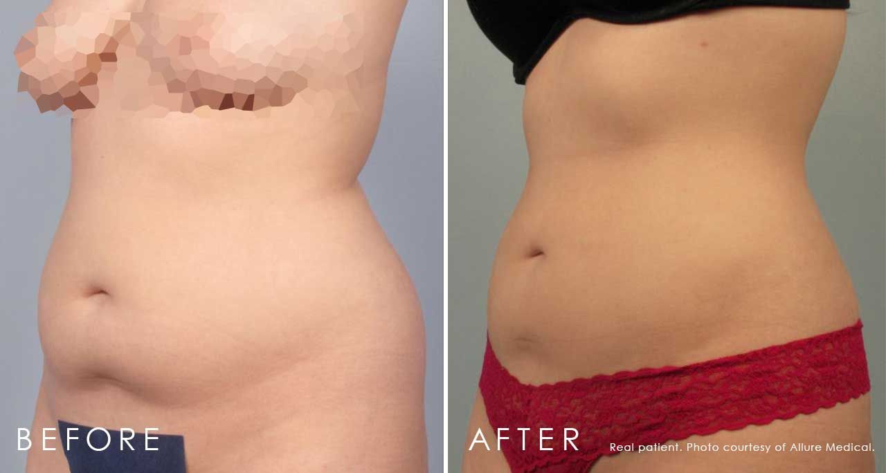 Before and After Liposuction treatment #3