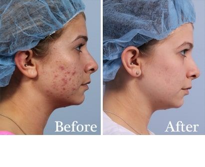 Before and After Acne Treatment treatment #2