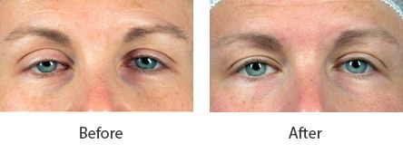 Before and After Cosmetic Eyelid Surgery treatment #2
