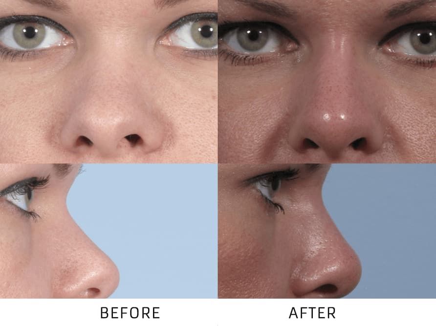 Before and After Non Surgical Nose Job treatment #3