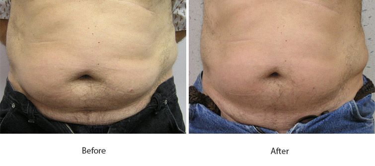 Before and After Cellulite Injections treatment #1