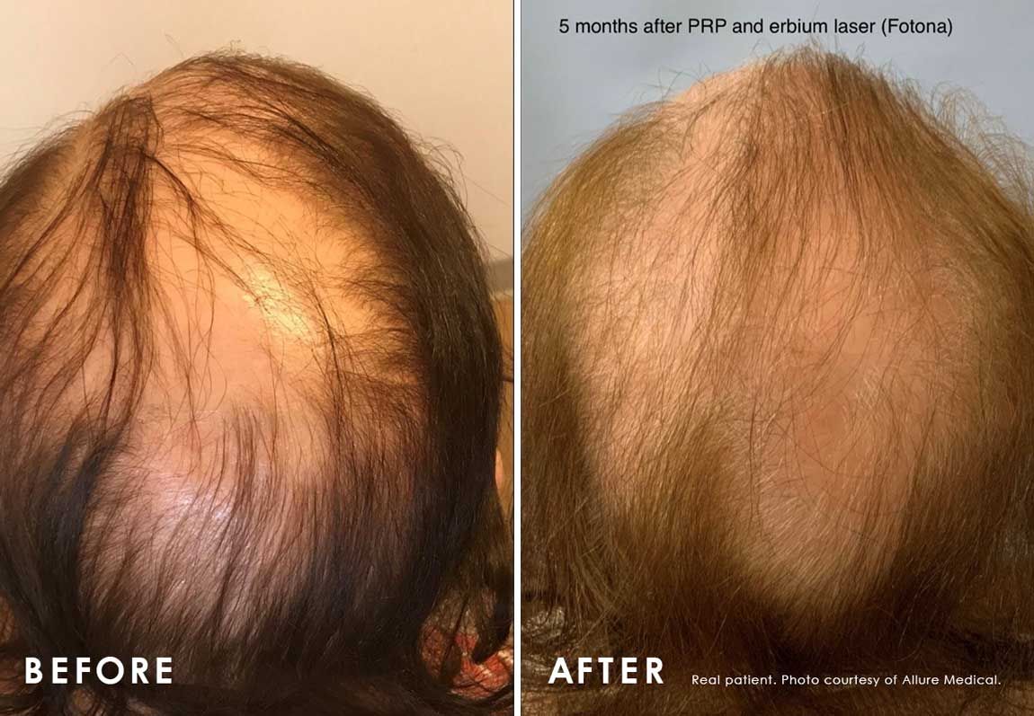 Before and After Alopecia Treatment treatment #2