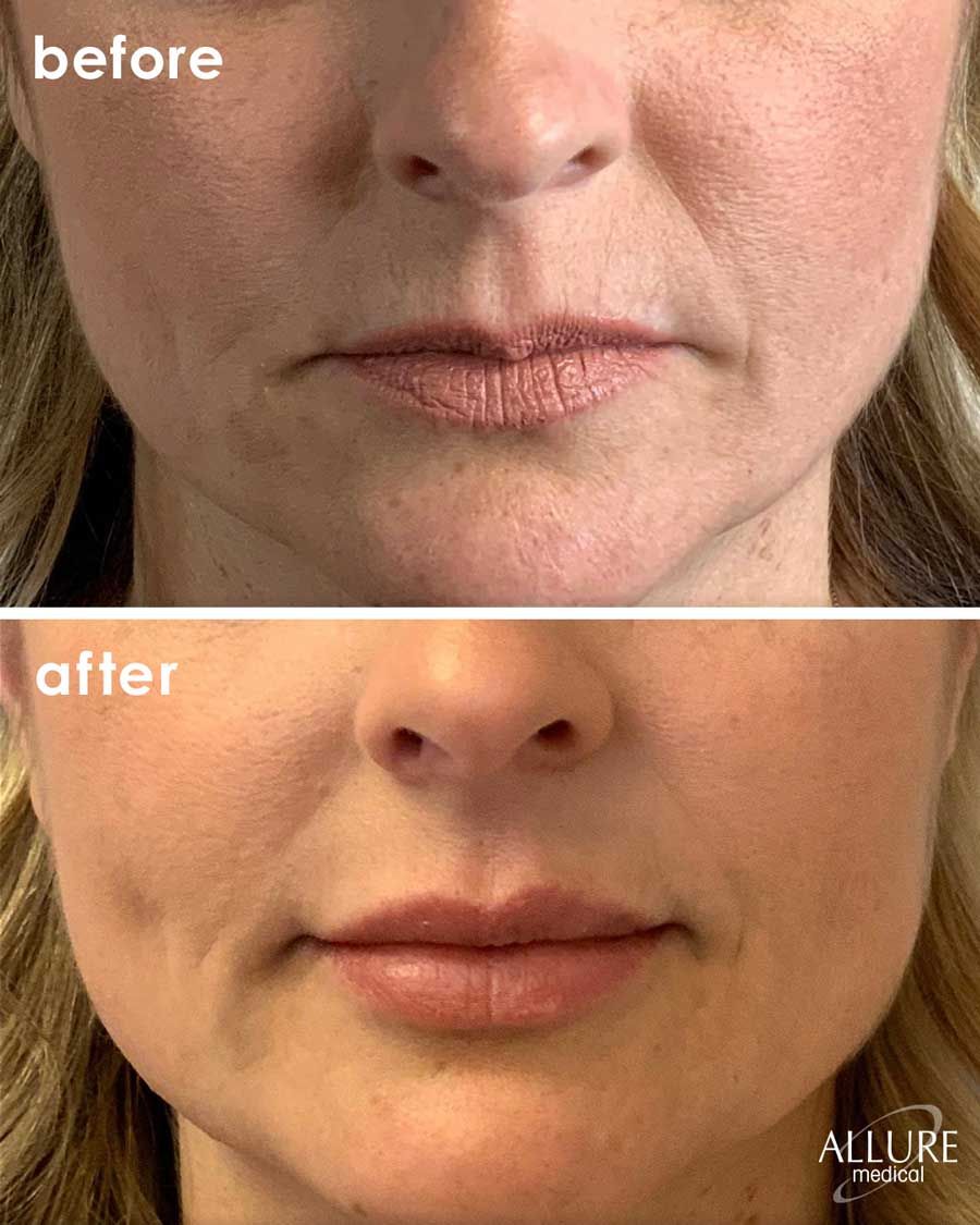 Before and After Lip Filler treatment #2